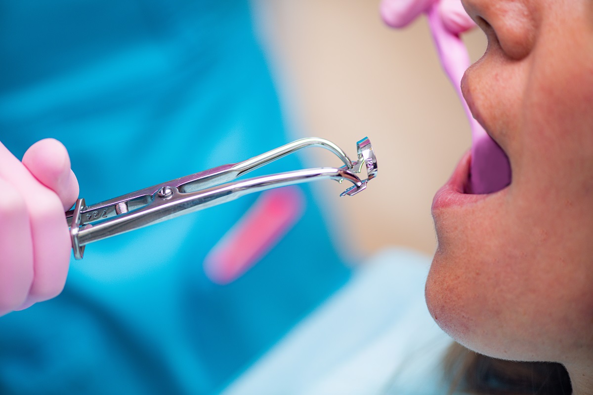 Agiamo sui tessuti interni del dente